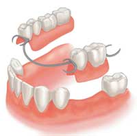 Dentures Partials
